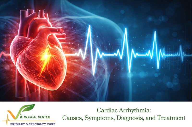 Cardiac Arrhythmia: Causes, Symptoms, Diagnosis, and Treatment